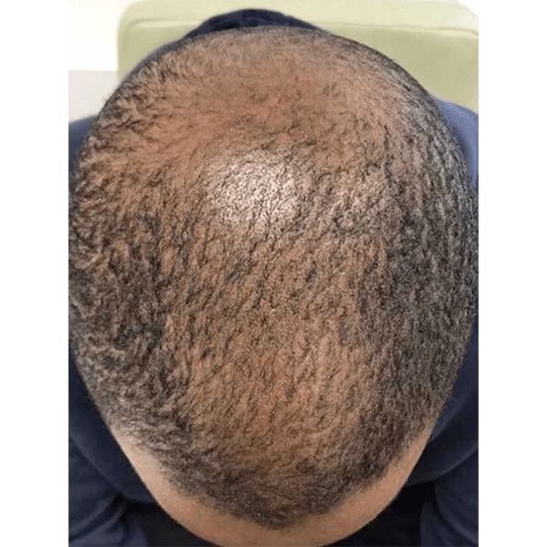 Advanced Hair System Kit