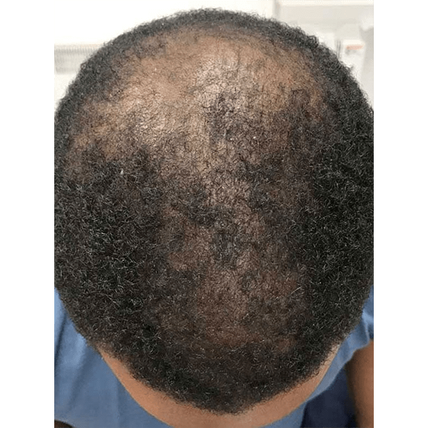 Advanced Hair System Kit