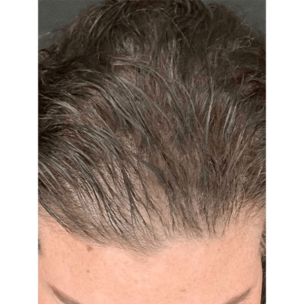 Advanced Hair System Kit