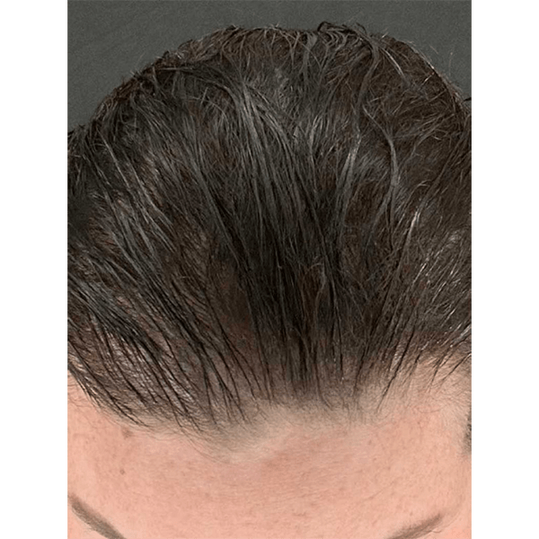 Advanced Hair System Kit